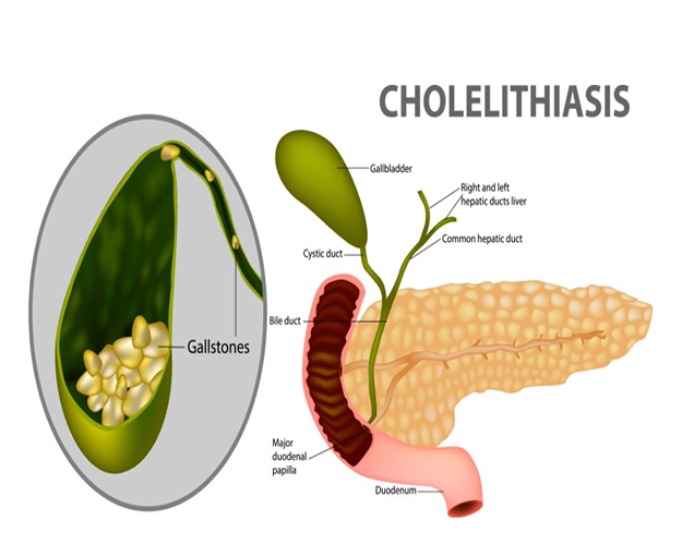 Cholelithiasis awareness guide by ITM Hospital showing gallbladder, causes, symptoms, and treatment options