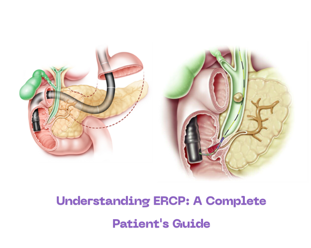 Endoscopic Retrograde Cholangiopancreatography (ERCP) procedure illustration showing bile and pancreatic ducts.