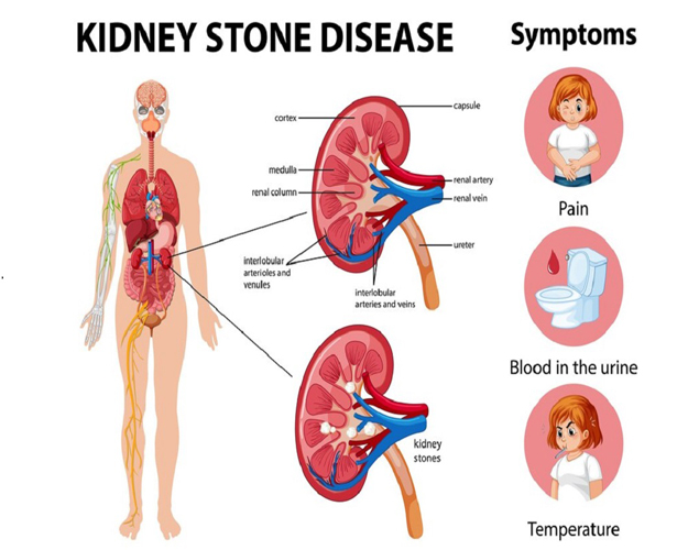 Clarifying Kidney Stone Solutions: An Essential Guide to Shock Wave Lithotripsy at ITM Hospital, Gwalior