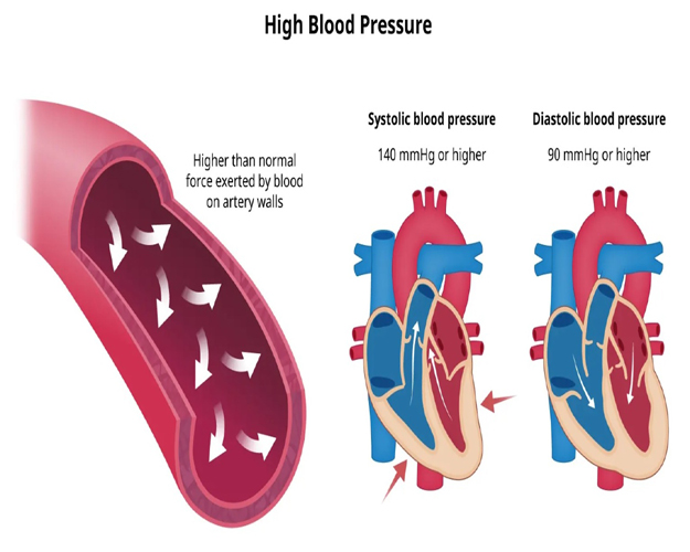 Hypertension: Causes, Cure, and Care – A Guide by ITM Hospital, Gwalior