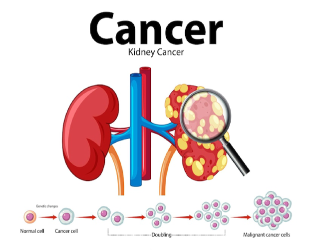 Comprehensive Care for Kidney and Bladder Cancer at ITM Hospital, Gwalior
