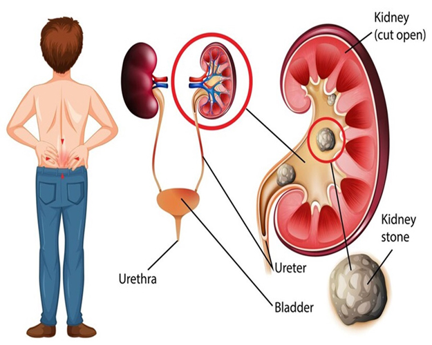 Breaking Down Kidney Stones: Understanding Shock Wave Lithotripsy and Treatment Options at ITM Hospital Gwalior