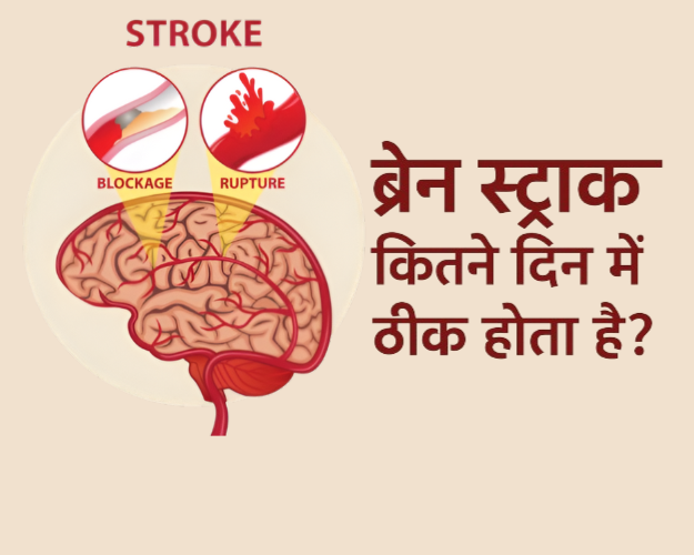 ब्रेन स्ट्रोक कितने दिन में ठीक होता है? कारण, लक्षण और उपचार 