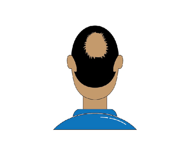 The Truth About Hair Transplants: What You Need to Know