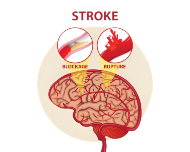 How High Blood Pressure Increases Stroke Risk: Prevention Tips